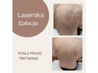 Laserska epilacija celih ledja,vrata i ramena za muškarce